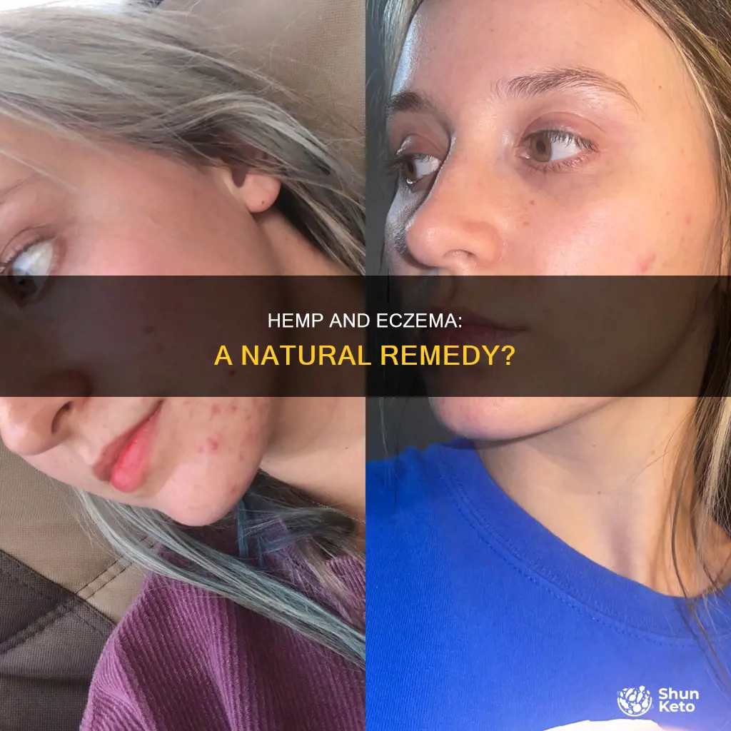 is hemp ok in eczema diet