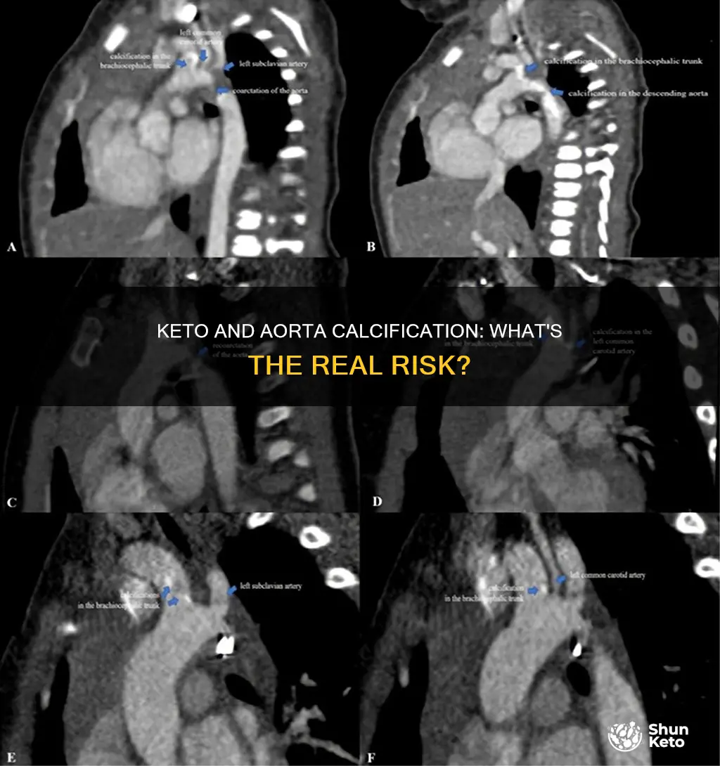 is keto bad for calcification of aorta