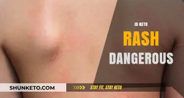 Is Keto Rash Dangerous? Understanding Symptoms, Risks, and Treatment Options