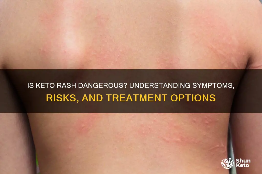 is keto rash dangerous