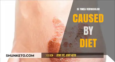 Tinea Versicolor: Can Diet Cause It?