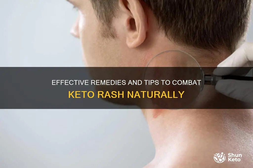 what can i do about keto rash