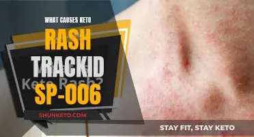 Keto Rash: Understanding the Cause and TrackID SP-006