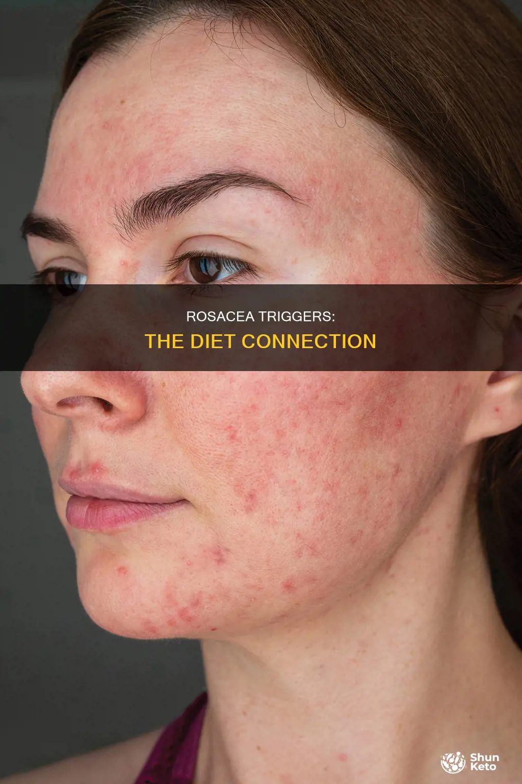 what causes rosacea diet