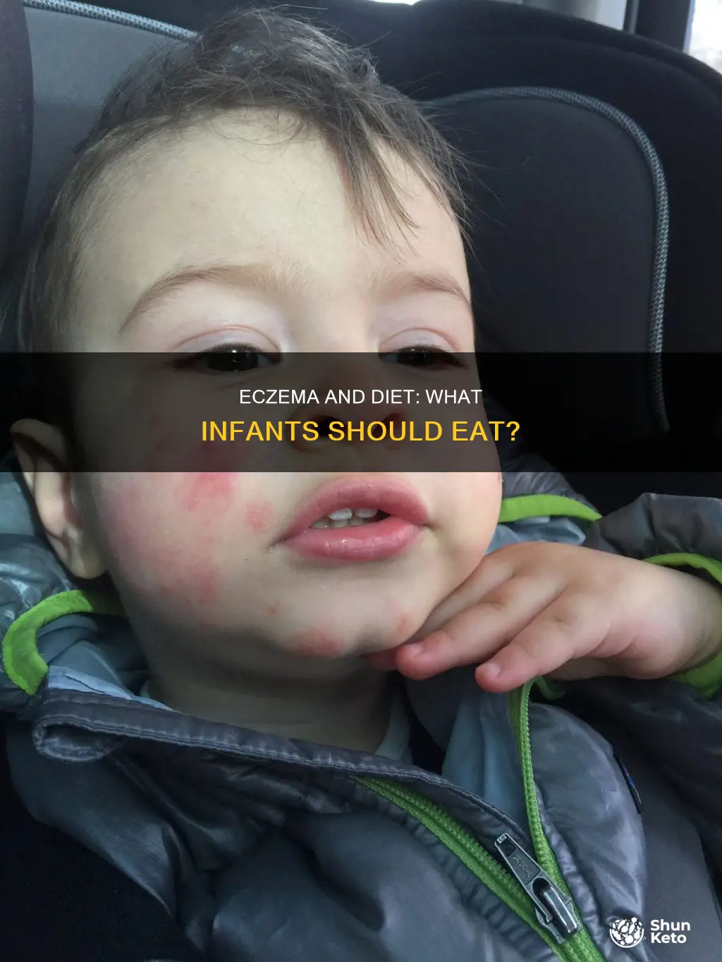 what diet should you follow for infant with eczema