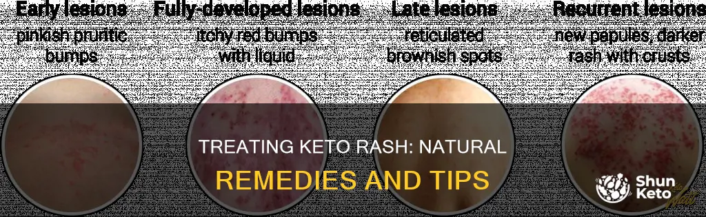 what helps keto rash