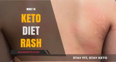 Understanding Keto Diet Rash: Causes, Symptoms, and Effective Remedies
