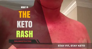 Understanding Keto Rash: Causes, Symptoms, and Effective Treatment Options