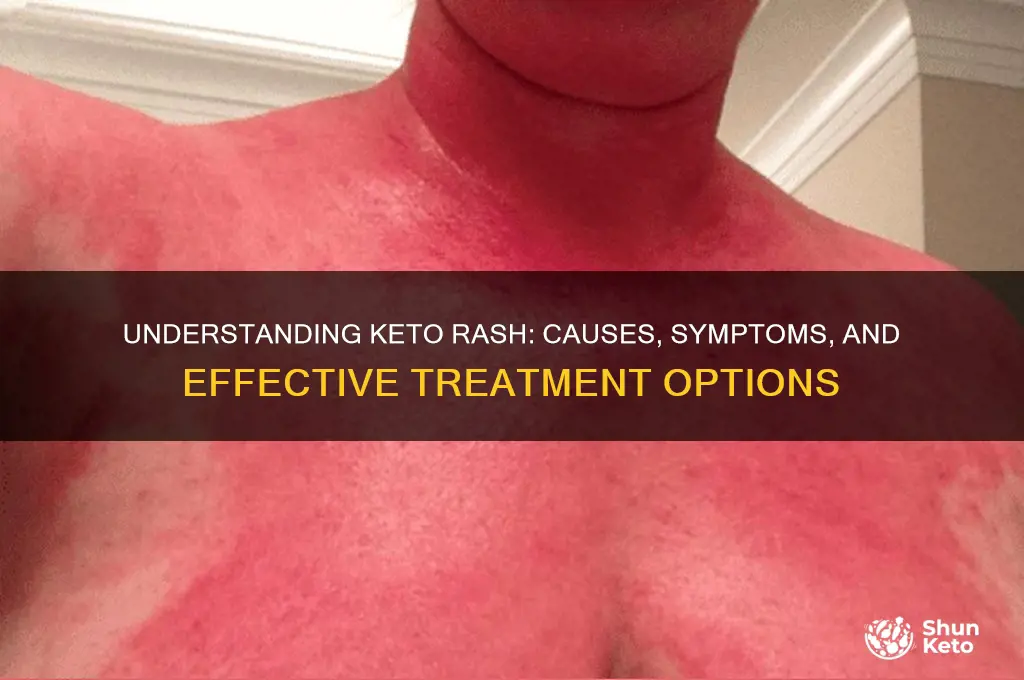 what is the keto rash