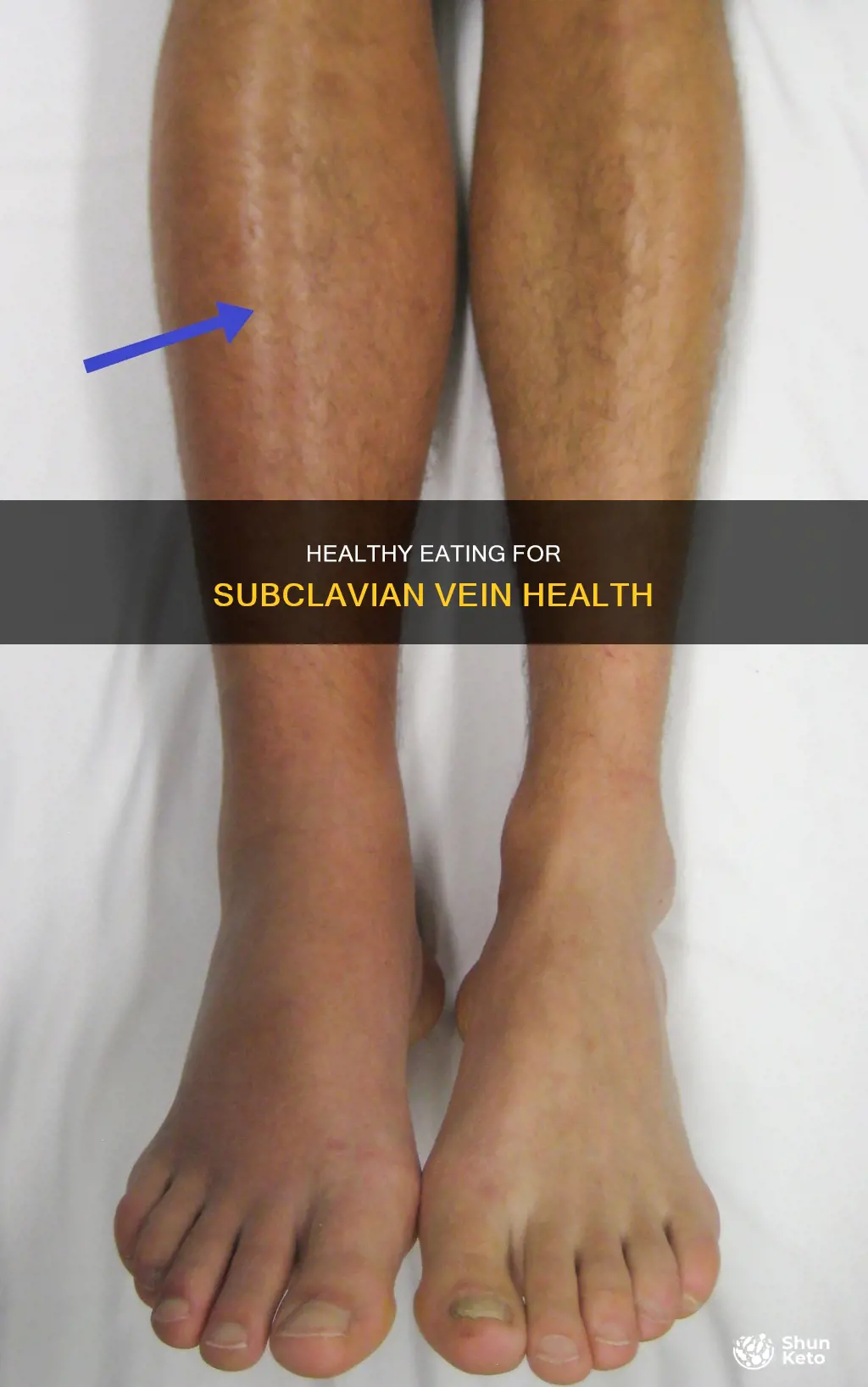 what kind diet for a subclavian