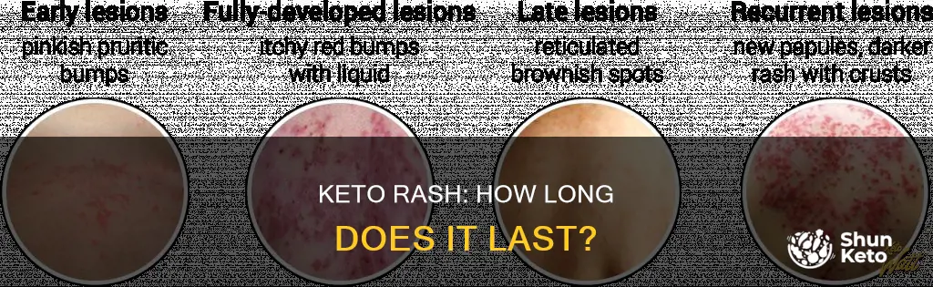 when will keto rash go away