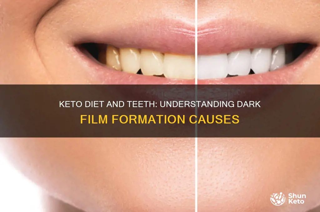 why dark film on teeth keto diet