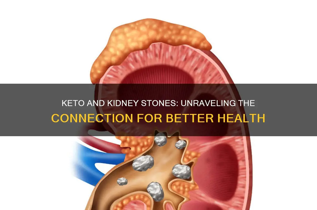 why do i get more kidney stones when eating keto