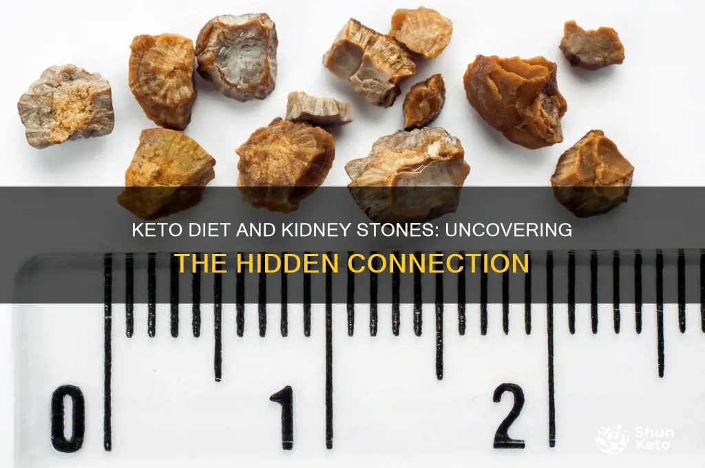 why do you have kidney stones due to keto diet