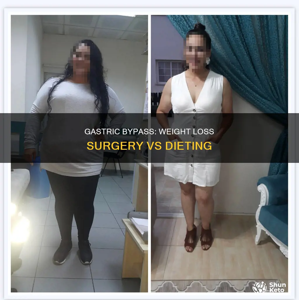 why does gastric btpass cause weght loss vs dieting
