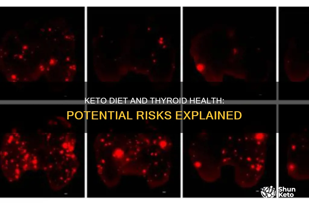 why is keto diet bad for thyroid