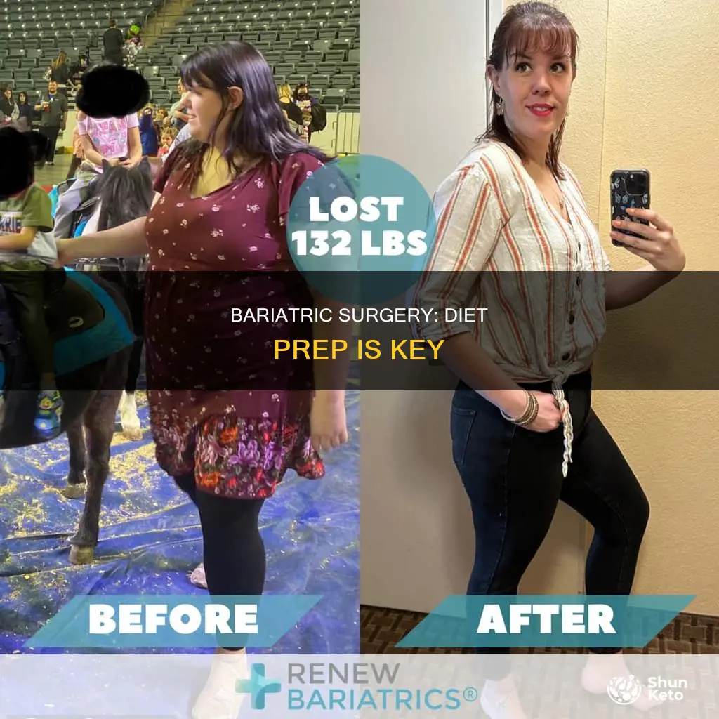 why preparing for bariatric surgery diet important