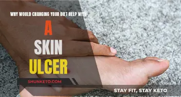 Diet Changes: Healing Skin Ulcers from Within