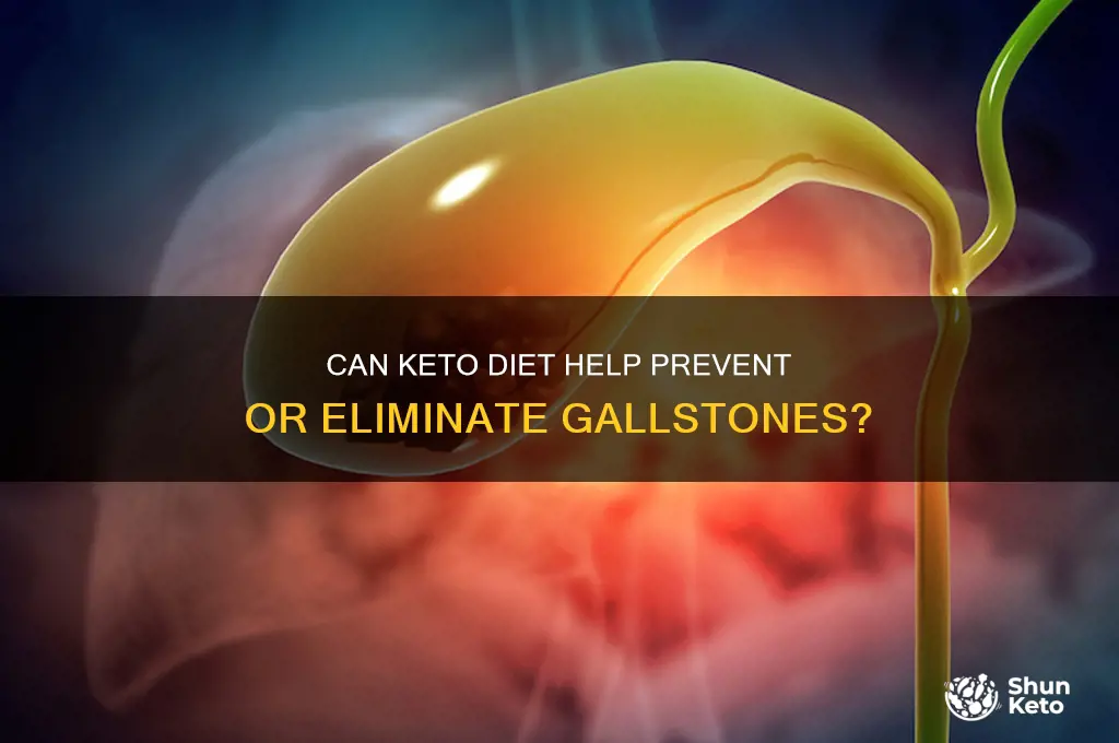 will a keto diet eliminate gallstones
