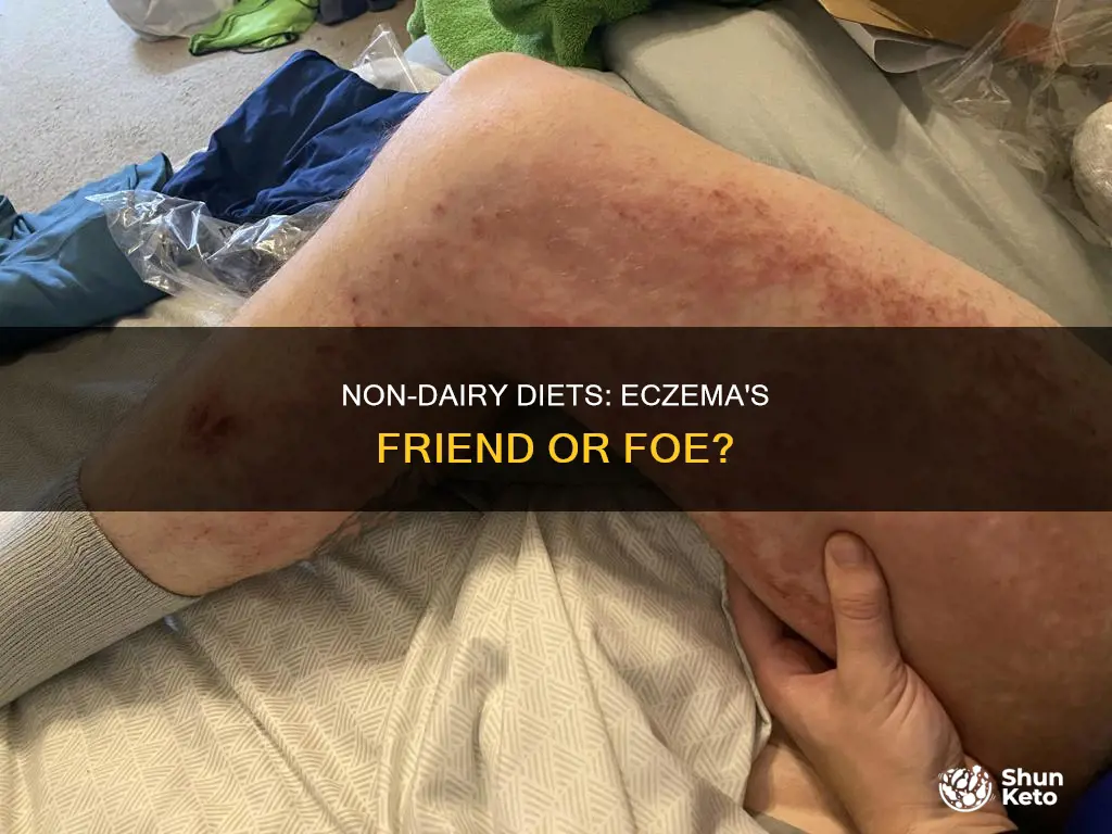 will a non dairy diet help eczema