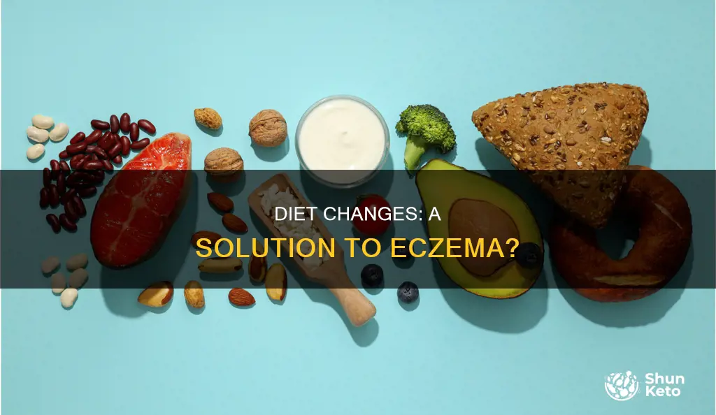 will changing your diet help with ezcema