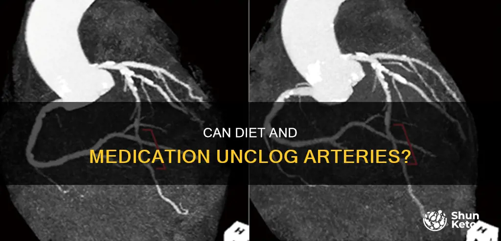 will clogged arteries become unclogged by diet and medication