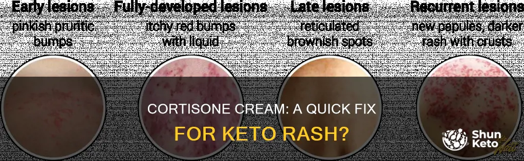 will cortisone cream help keto rash