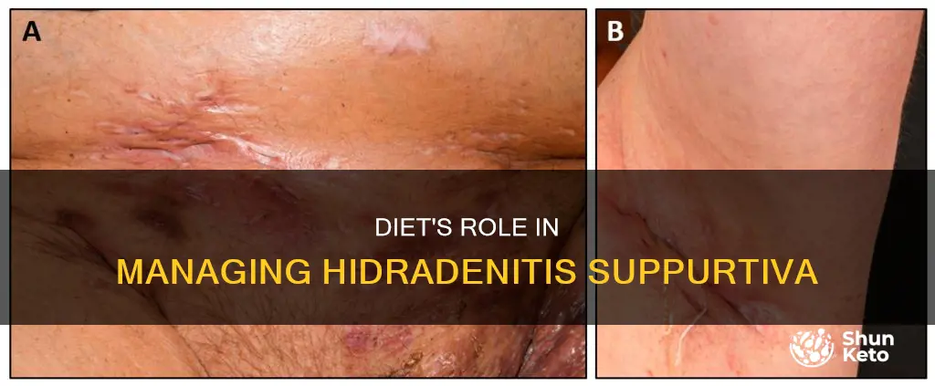 will diet help hidradenitis supp
