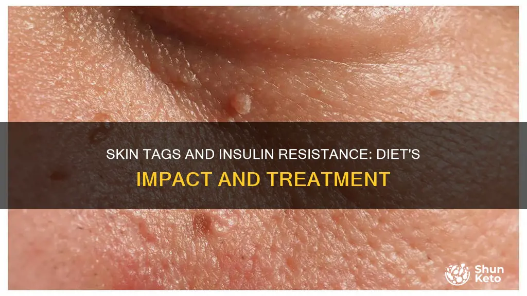 will insolin resistance skintags go away if dieting