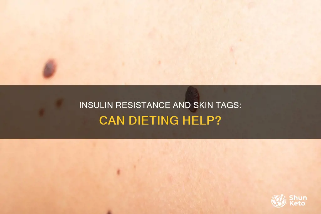 will insolin resistance skintags go away if dieting