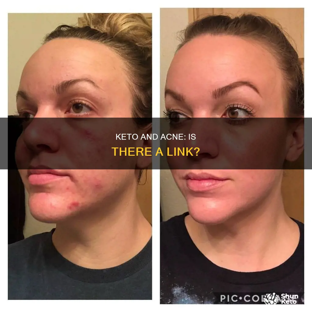 will keto cause acne