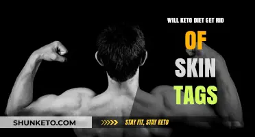 Can Keto Diet Eliminate Skin Tags? Exploring the Connection