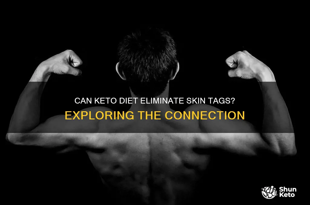 will keto diet get rid of skin tags