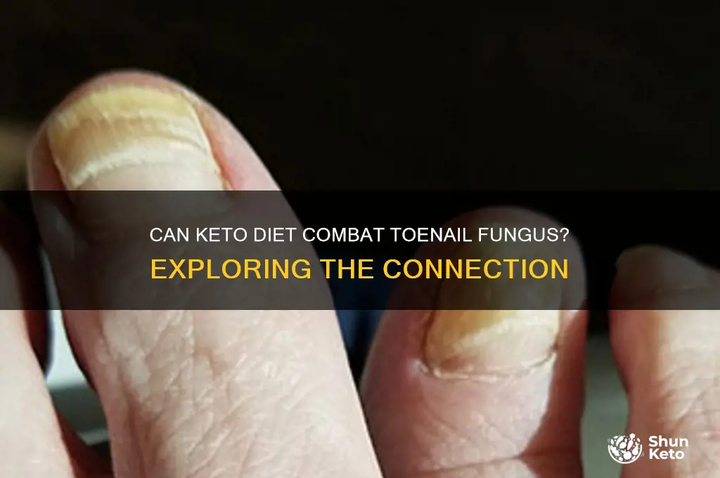will keto diet help toe nail fungus