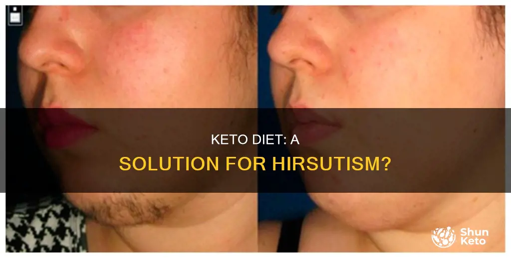 will keto help hirsutism