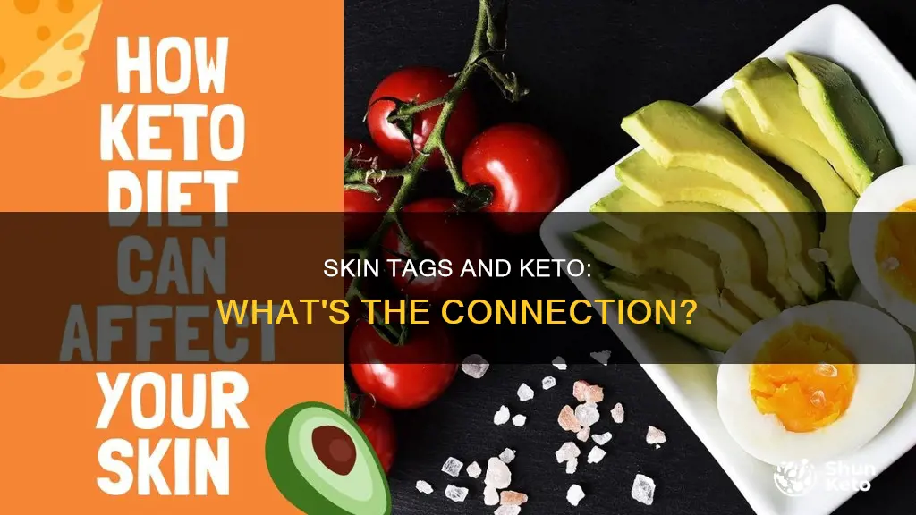 will skin tags go away on keto