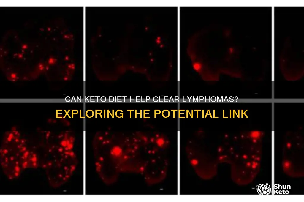will the keto diet clear up lympomas